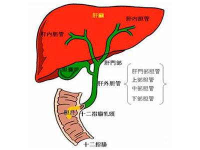 肝外膽管結石