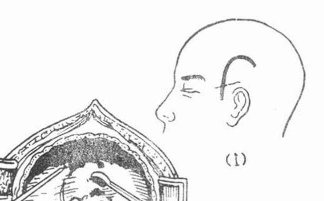 頭皮血腫
