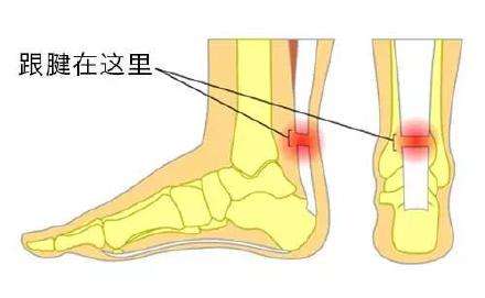 跟腱斷裂