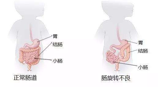 先天性腸疾病