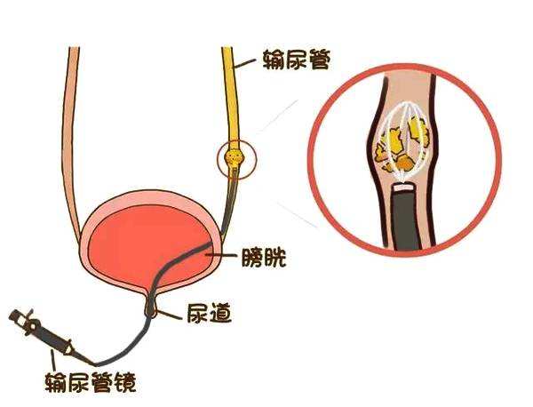 輸尿管損傷