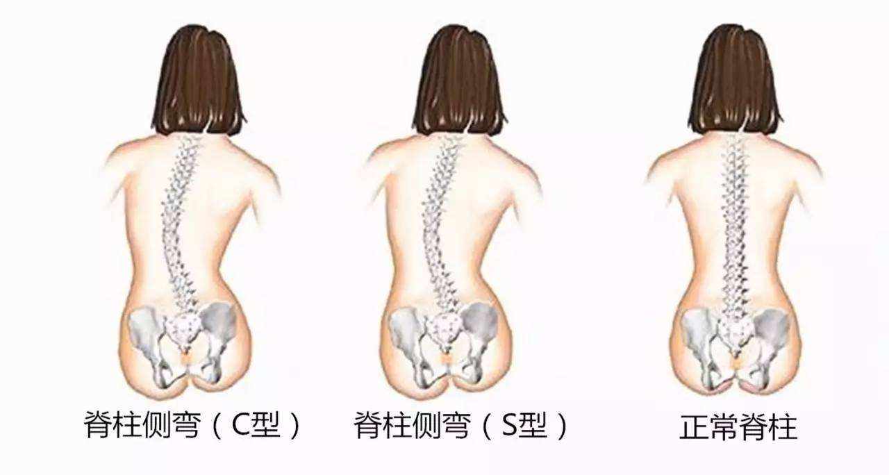 脊柱側彎