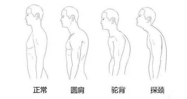 青年性駝背