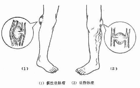 動靜脈瘺