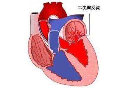 二尖瓣關閉不全