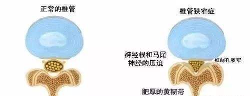 胸椎管狹窄