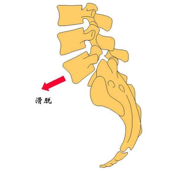 腰椎滑脫