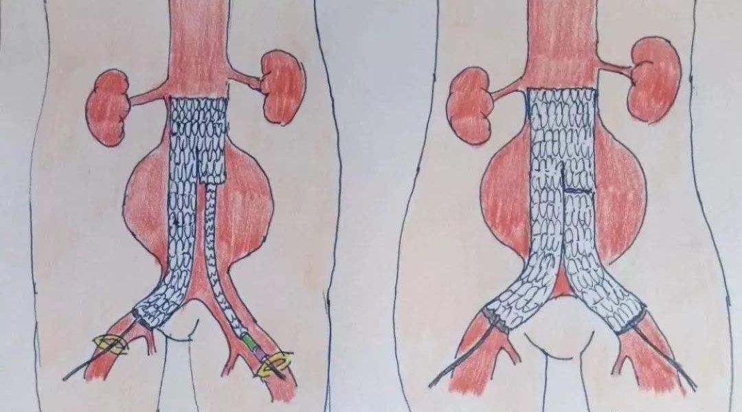 腹主動脈瘤