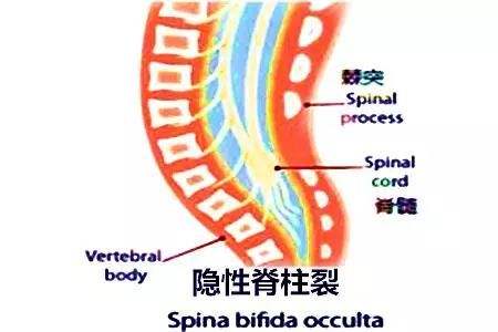 隱性脊柱裂