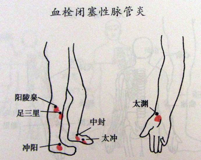 脈管炎