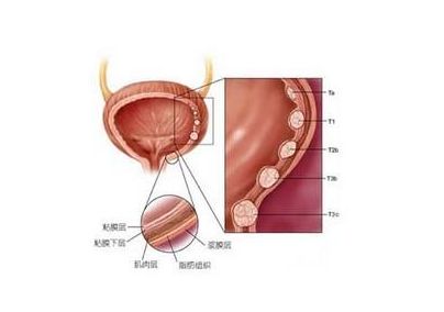 膀胱腫瘤