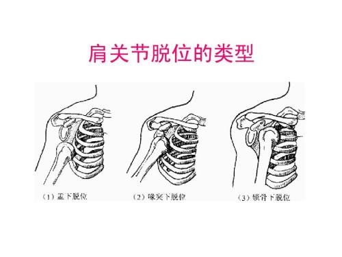 肩關節(jié)脫位