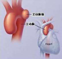 主動脈瘤
