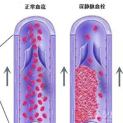 靜脈疾病