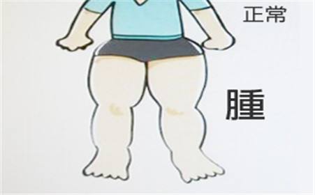 下肢淋巴水腫
