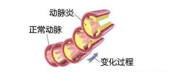 主動脈炎