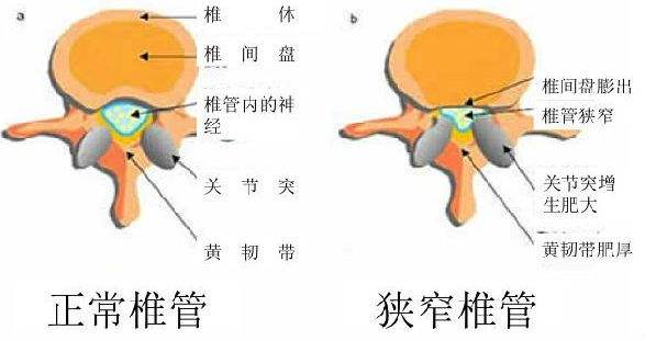 腰椎管狹窄