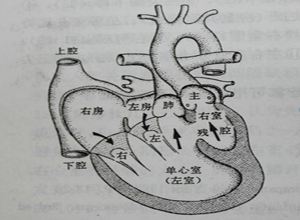 單心室