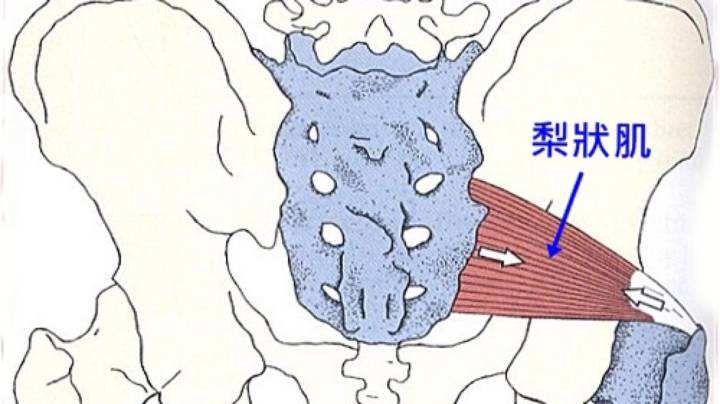 梨狀肌綜合征