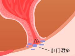 肛門濕疹