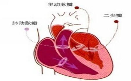 先天性二尖瓣關閉不全