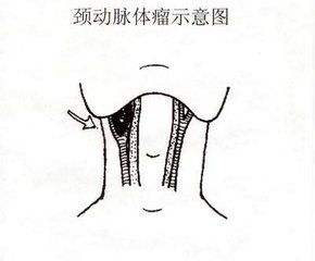 頸動脈體瘤
