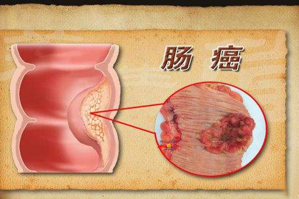 腸癌