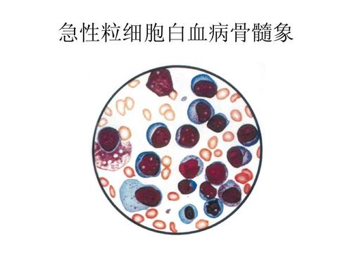 急性粒細胞白血病