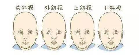 麻痹性斜視