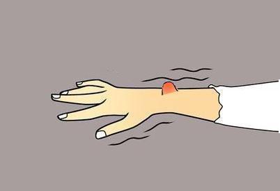脂肪瘤