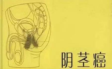 陰莖癌