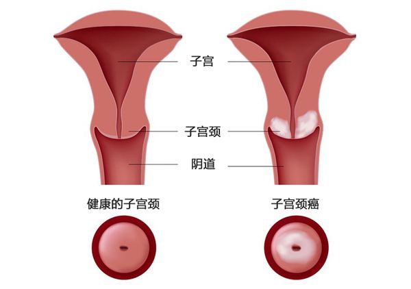 宮頸癌前病變