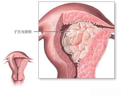 子宮內(nèi)膜癌