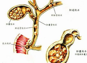 肝內膽管結石