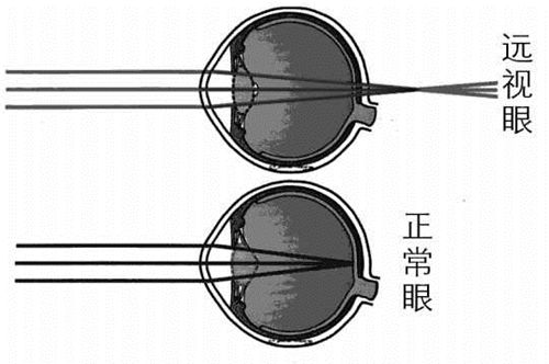遠(yuǎn)視