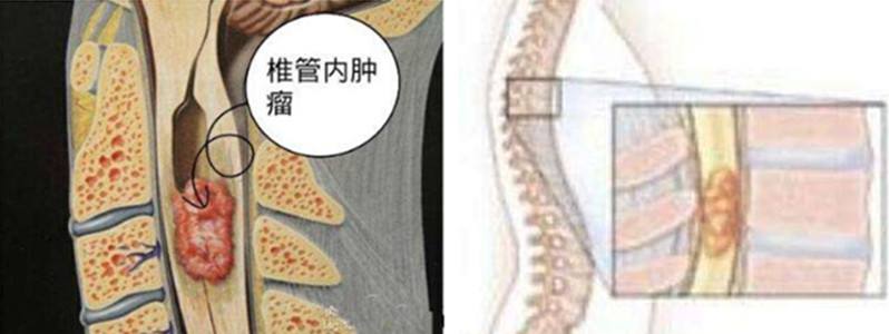 椎管內腫瘤