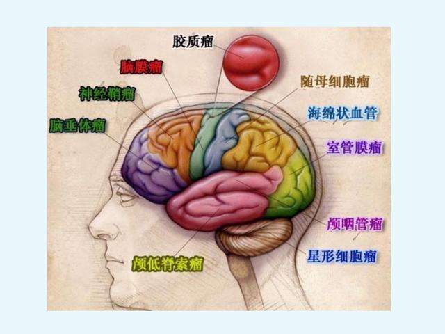 膠質瘤