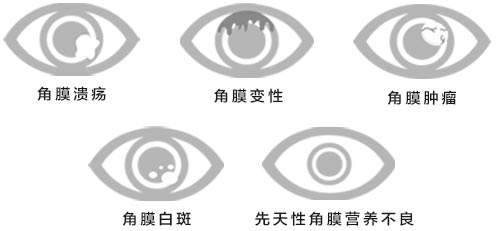 邊緣性角膜變性