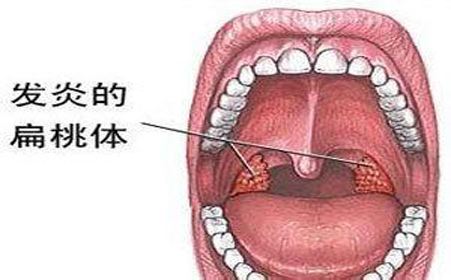 扁桃體癌