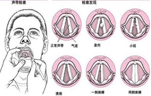 喉乳頭狀瘤