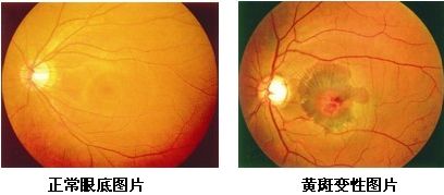 黃斑變性