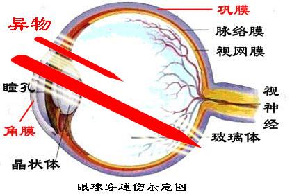 眼球穿通傷