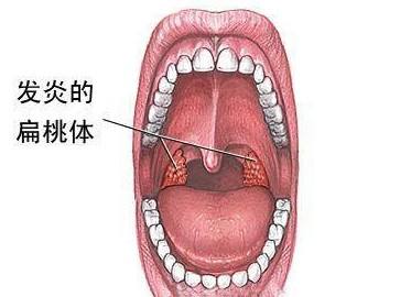 扁桃體炎