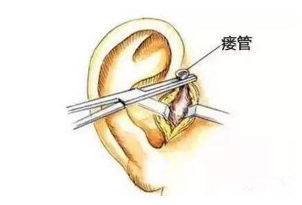 先天性耳前瘺管