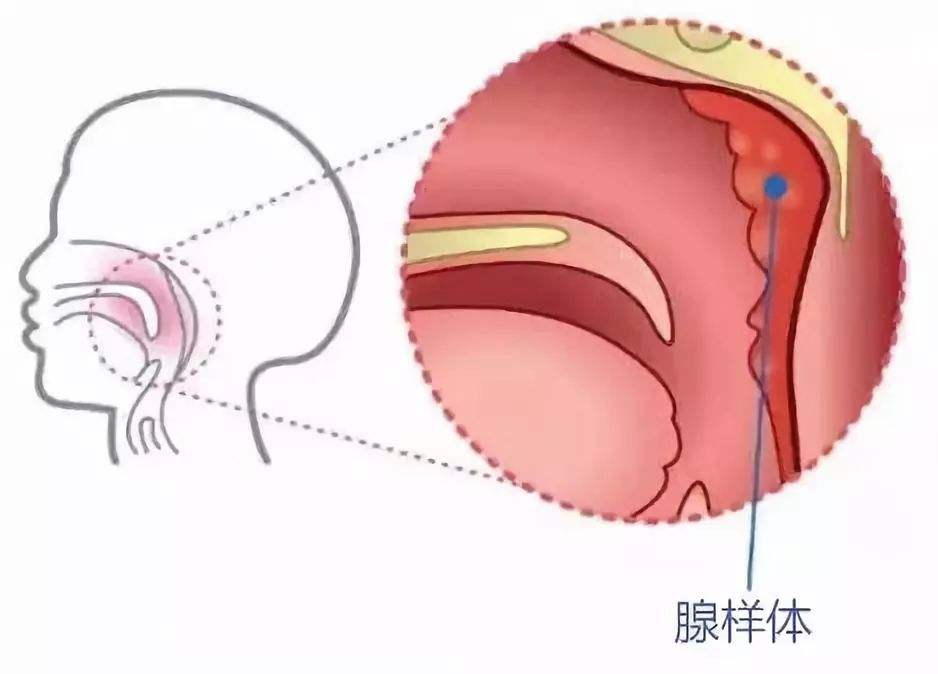 腺樣體炎