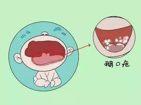 鵝口瘡