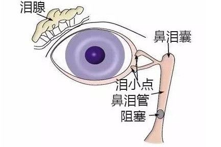 淚囊炎