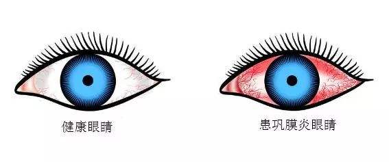 鞏膜炎