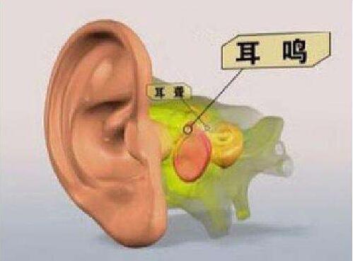 耳鳴