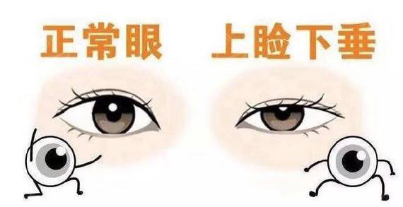 上瞼下垂